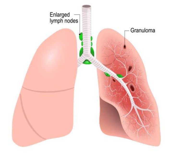 SARCOIDOSIS_3