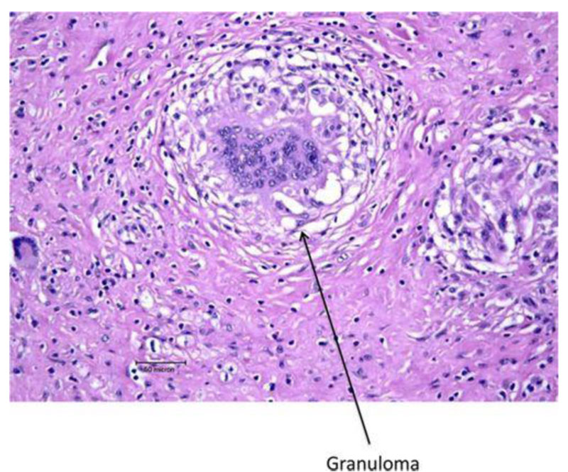 SARCOIDOSIS_4