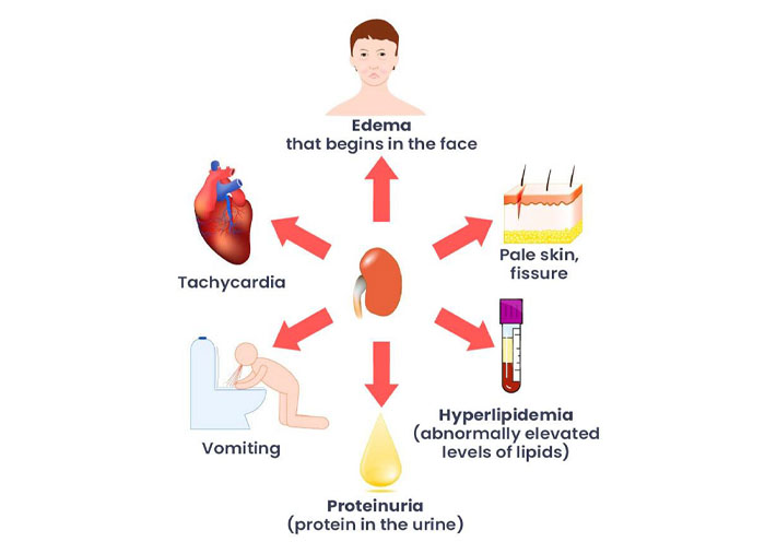 NEPHROTIC SYNDROME - Focus Dentistry