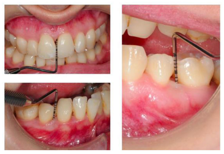 CHRONIC PERIODONTITIS_Clinical features