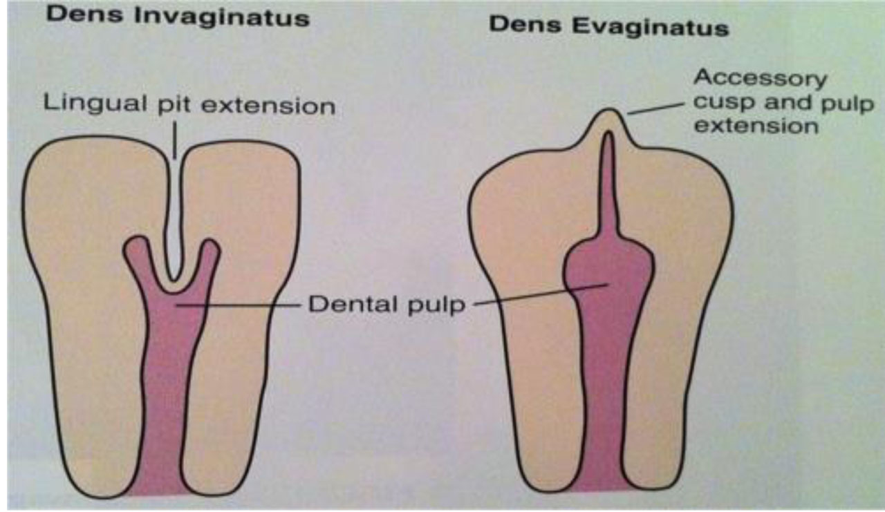 DENS EVAGINATUS