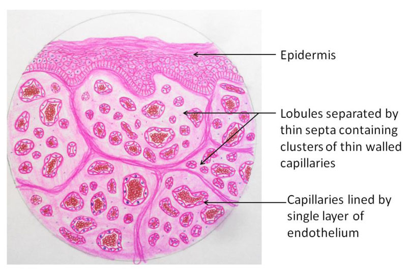 HAEMANGIOMA_3