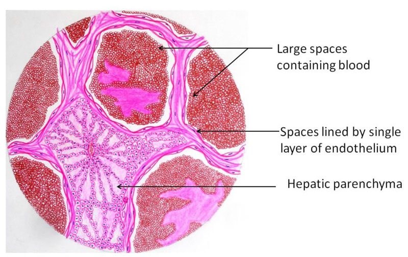 HAEMANGIOMA_4