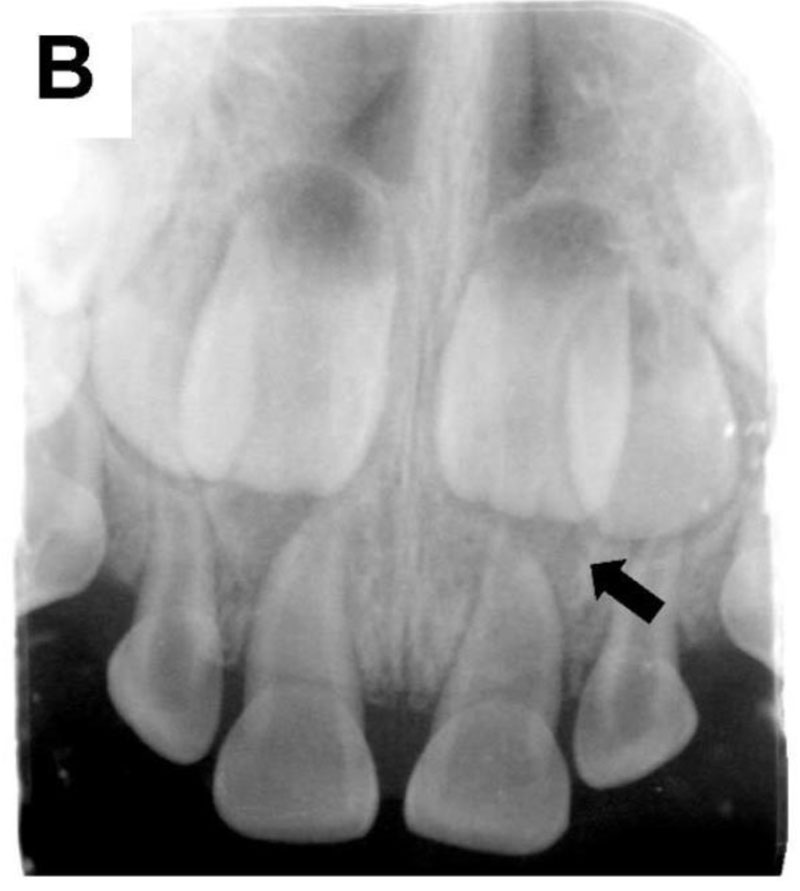 HYPOPHOSPHATEMIA_B