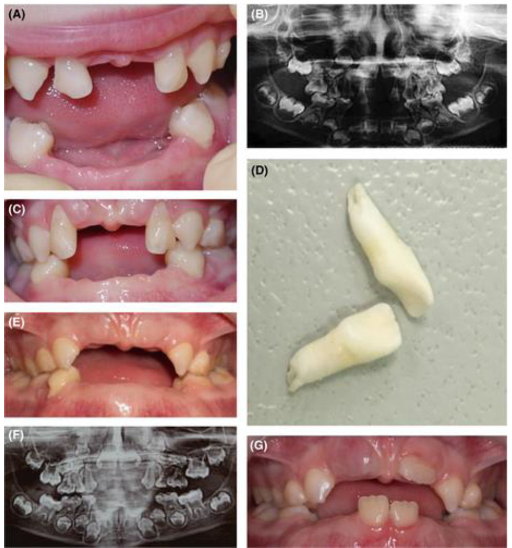 HYPOPHOSPHATEMIA_CASE 3