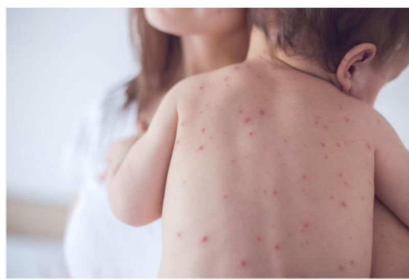 MEASLES VIRUS -symptoms