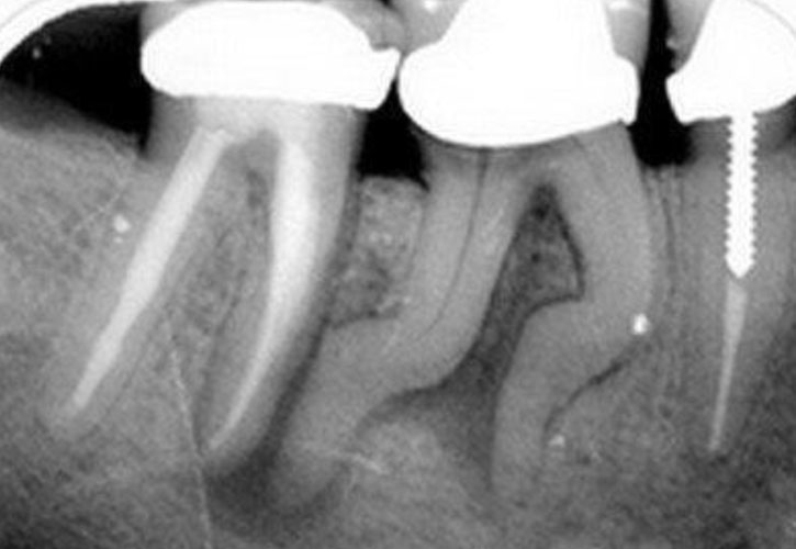 Radiographic Features-a