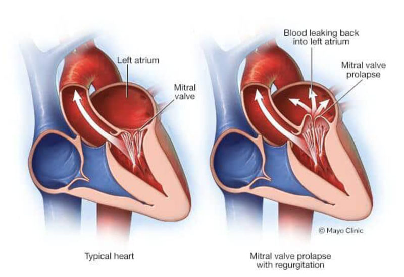 BARLOW SYNDROME_2