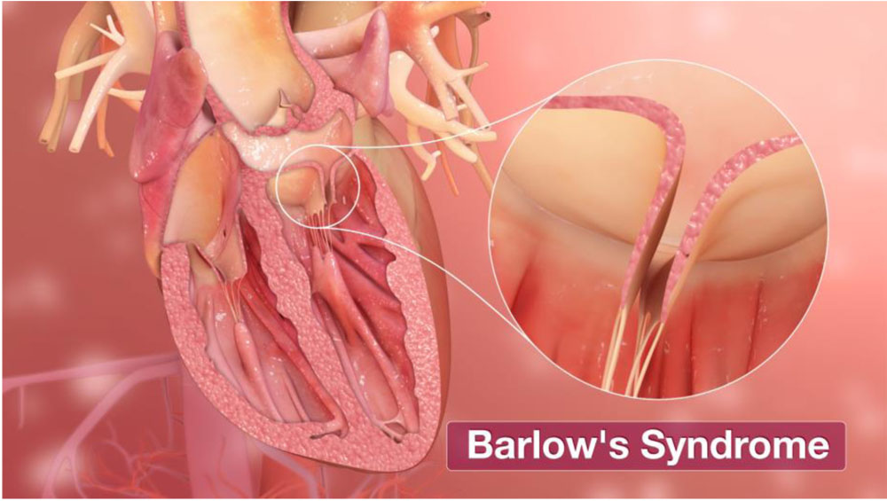 BARLOW SYNDROME_3