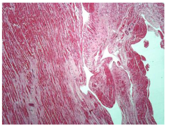 BARLOW SYNDROME_Microscopically