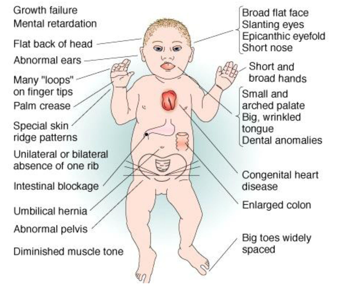 CYTOGENETIC_Down’s syndrome