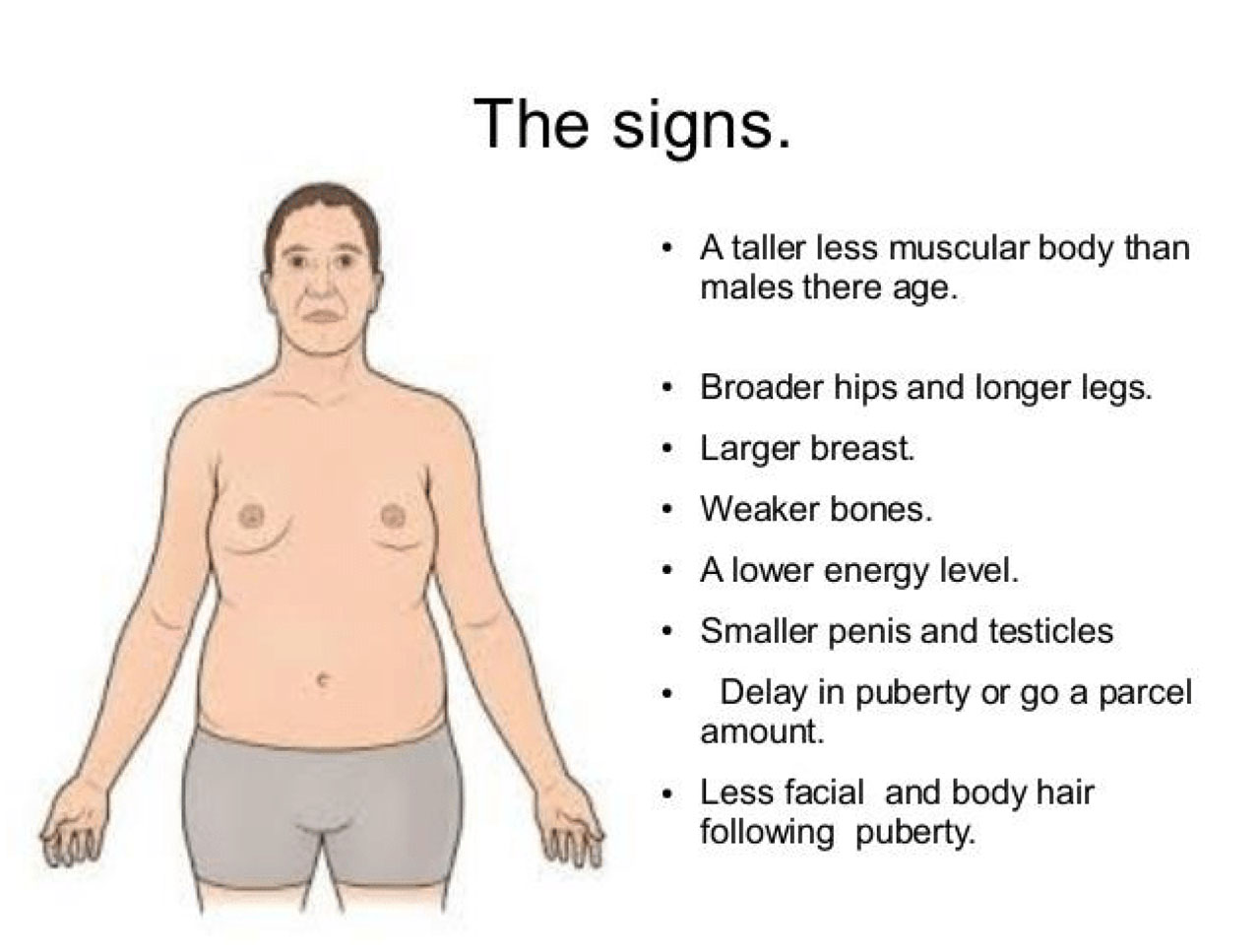 CYTOGENETIC_Klinefelter’s syndrome