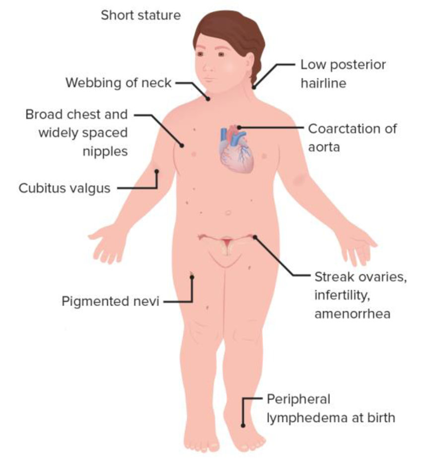 CYTOGENETIC_Turner’s syndrome