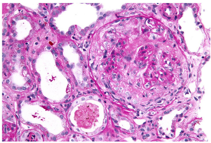 GOODPASTURE SYNDROME_Histologically