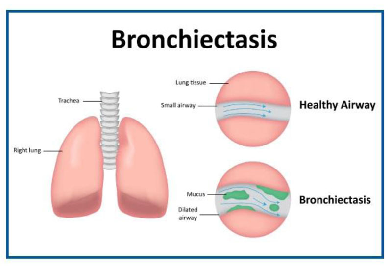 PAST MCQ DISCUSSION_Bronchiectasis