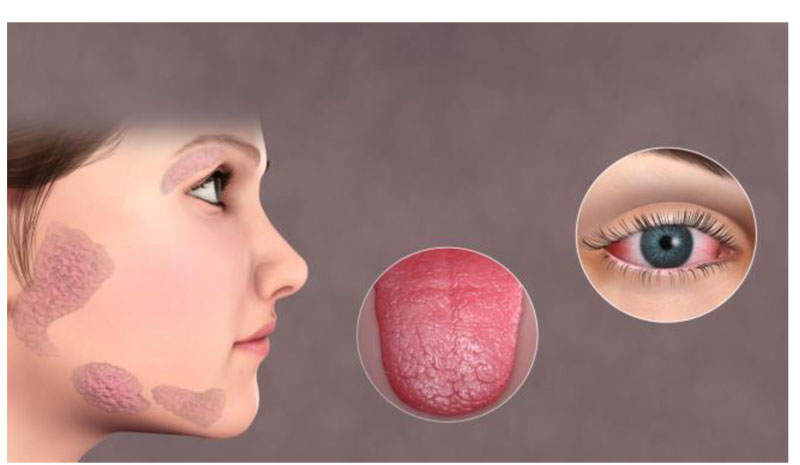 SJOGREN SYNDROME_