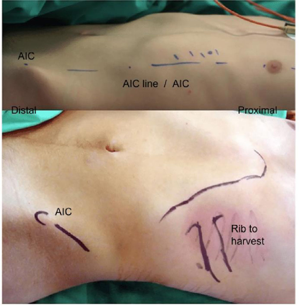 COSTOCHONDRAL GRAFT