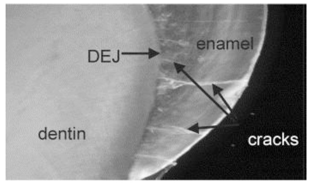 Dentinoenamel Junction