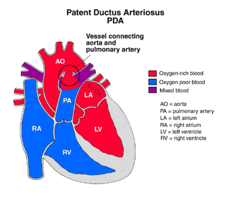 Patent ductus arteriosus_2