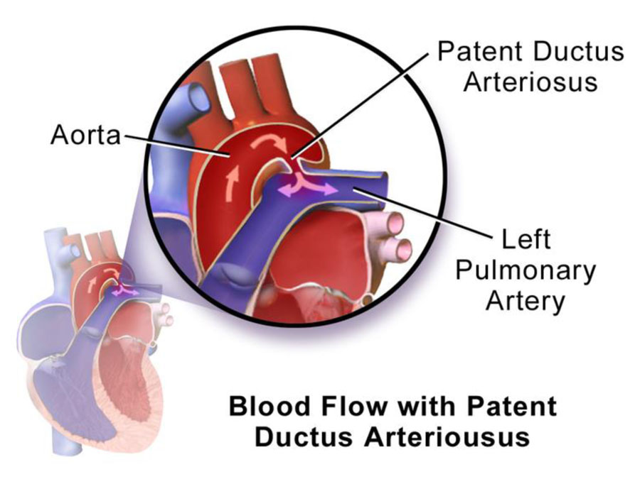 Patent ductus arteriosus_3