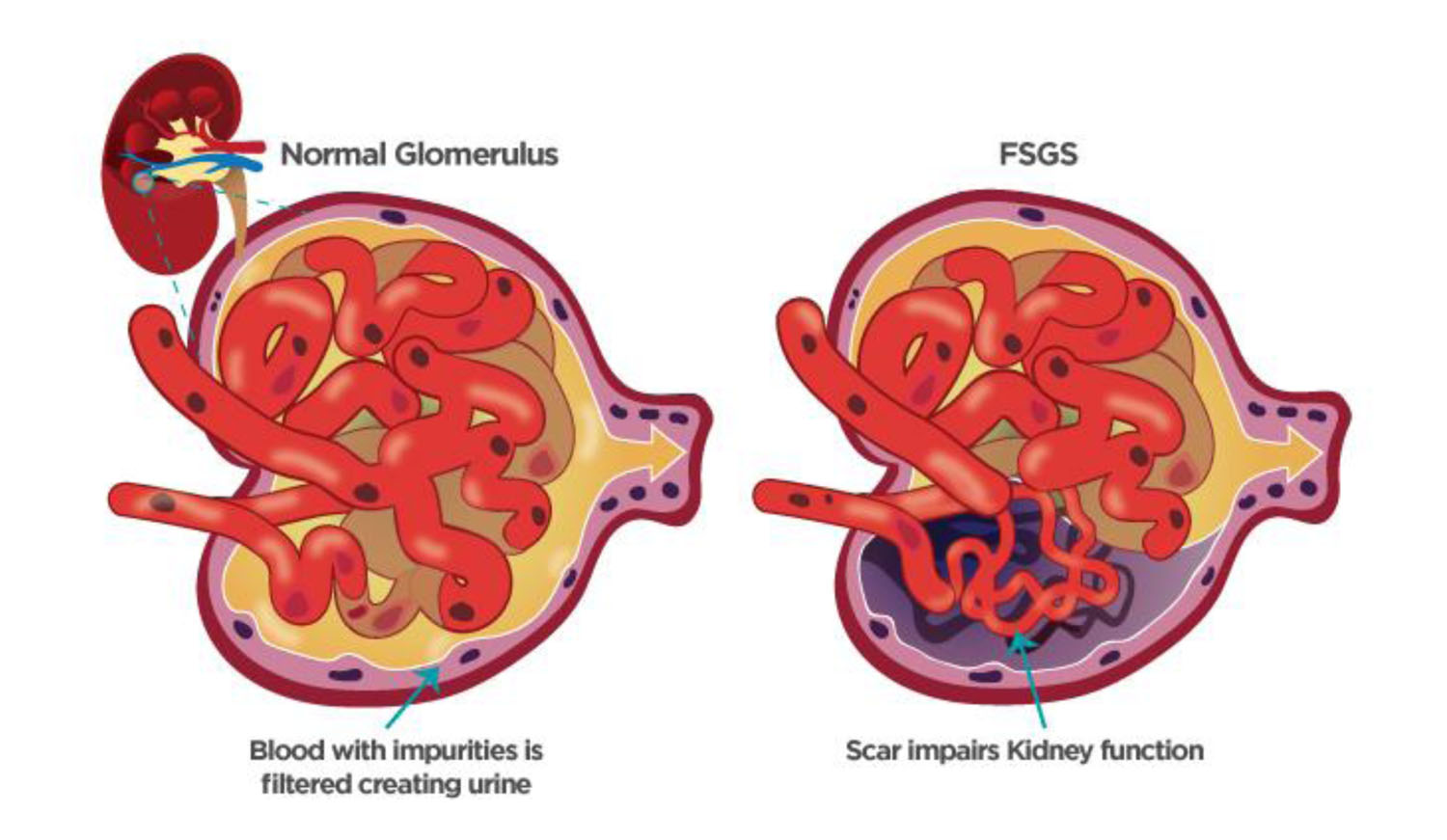 FOCAL SEGMENTAL GLOMERULOSCLEROSIS_